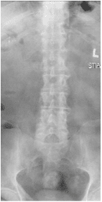 Las radiografías y la resonancia magnética de la columna lumbar mostraron espondilolistesis degenerativa L4-5