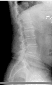 Las radiografías y la resonancia magnética de la columna lumbar mostraron espondilolistesis degenerativa L4-5