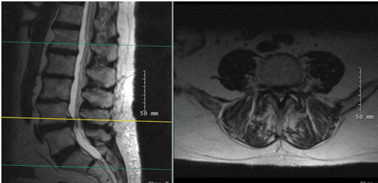 Las radiografías y la resonancia magnética de la columna lumbar mostraron espondilolistesis degenerativa L4-5