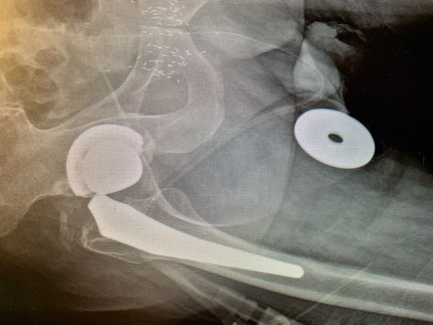 Case Study - Revision Hip 1a