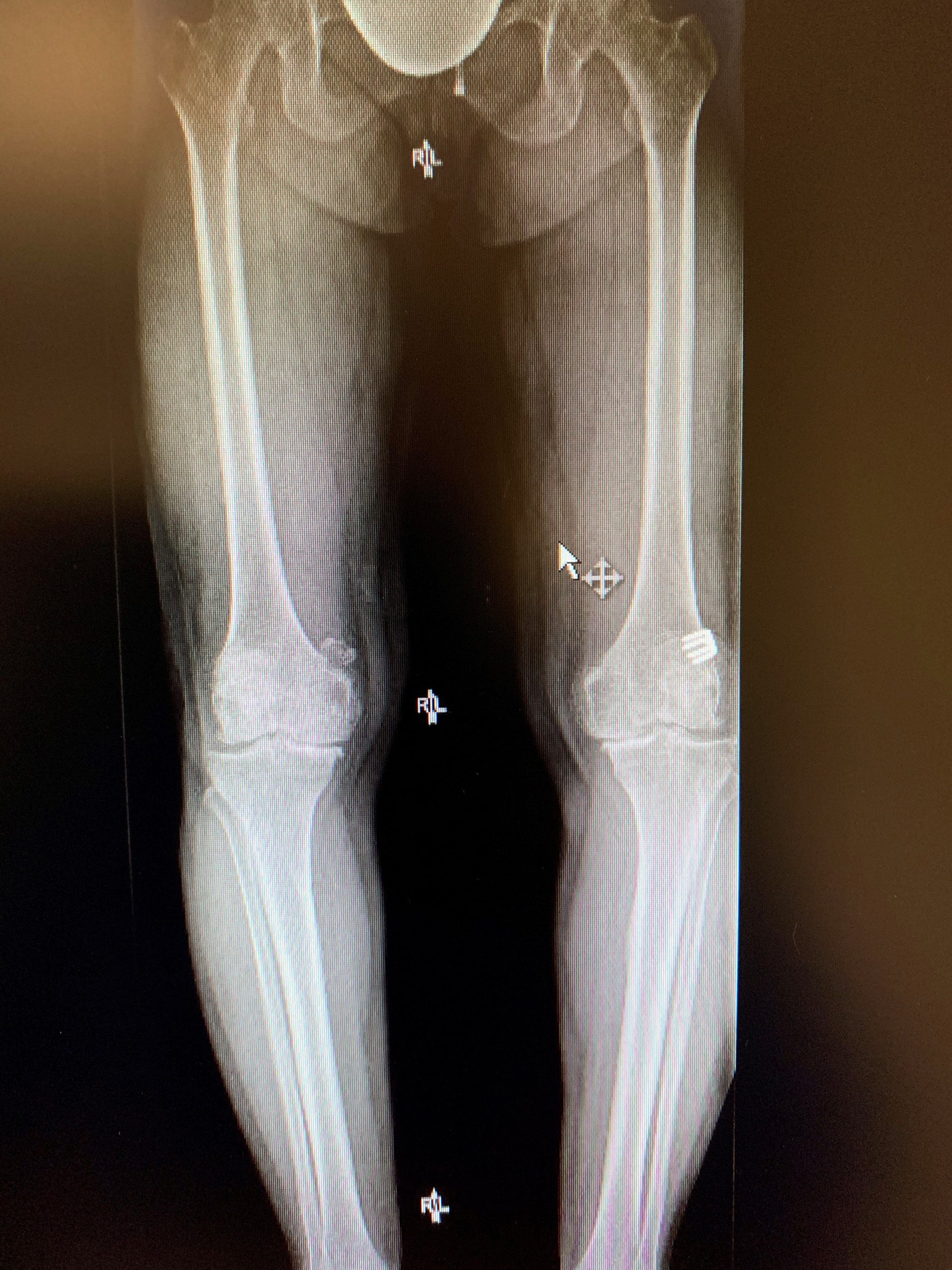 Reemplazo bilateral simultáneo de rodilla en una mujer de 54 años.