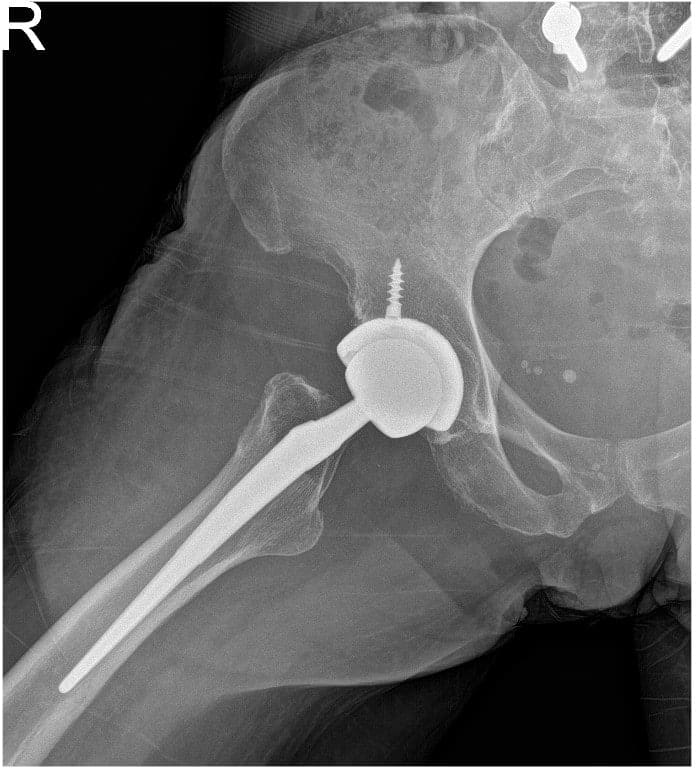 Post operative view xray of the hip Post operative view xray of the hip