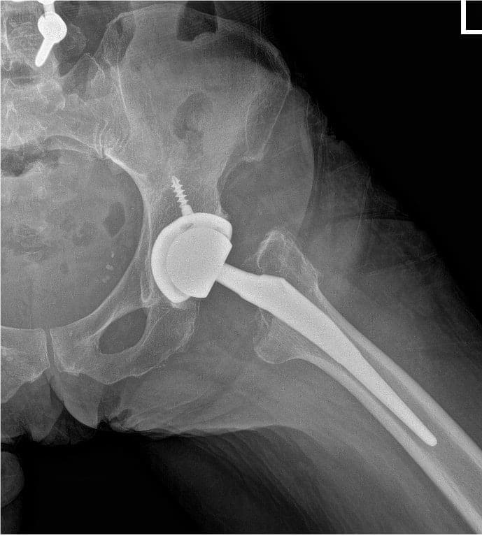 Post operative view xray of the hip Post operative view xray of the hip