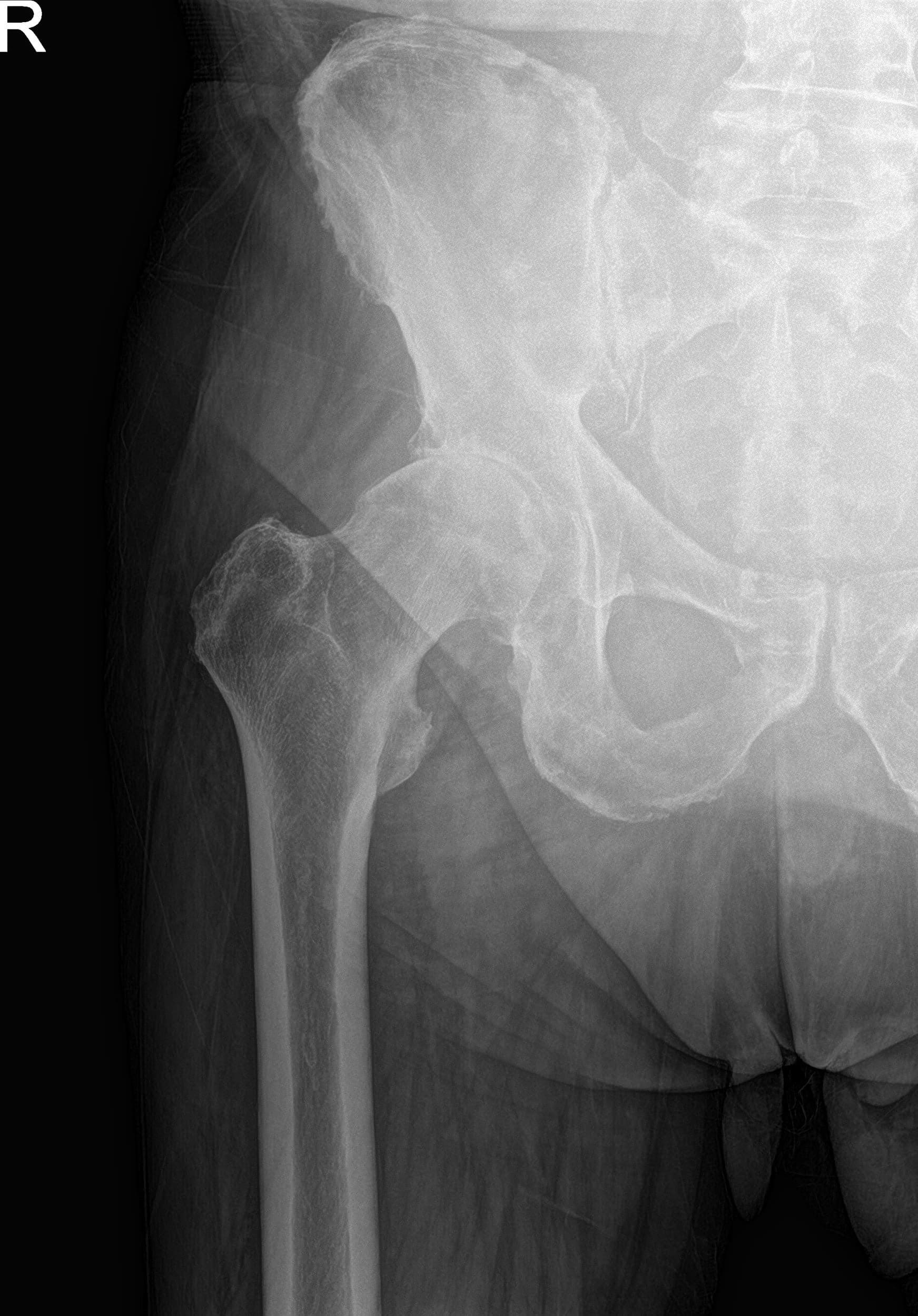Imágenes de rayos X preoperatorias que muestran la visión lateral de la pata de rana y la pata de rana de la cadera derecha Imágenes de rayos X preoperatorias que muestran la visión lateral de la pata de rana y la pata de rana de la cadera derecha