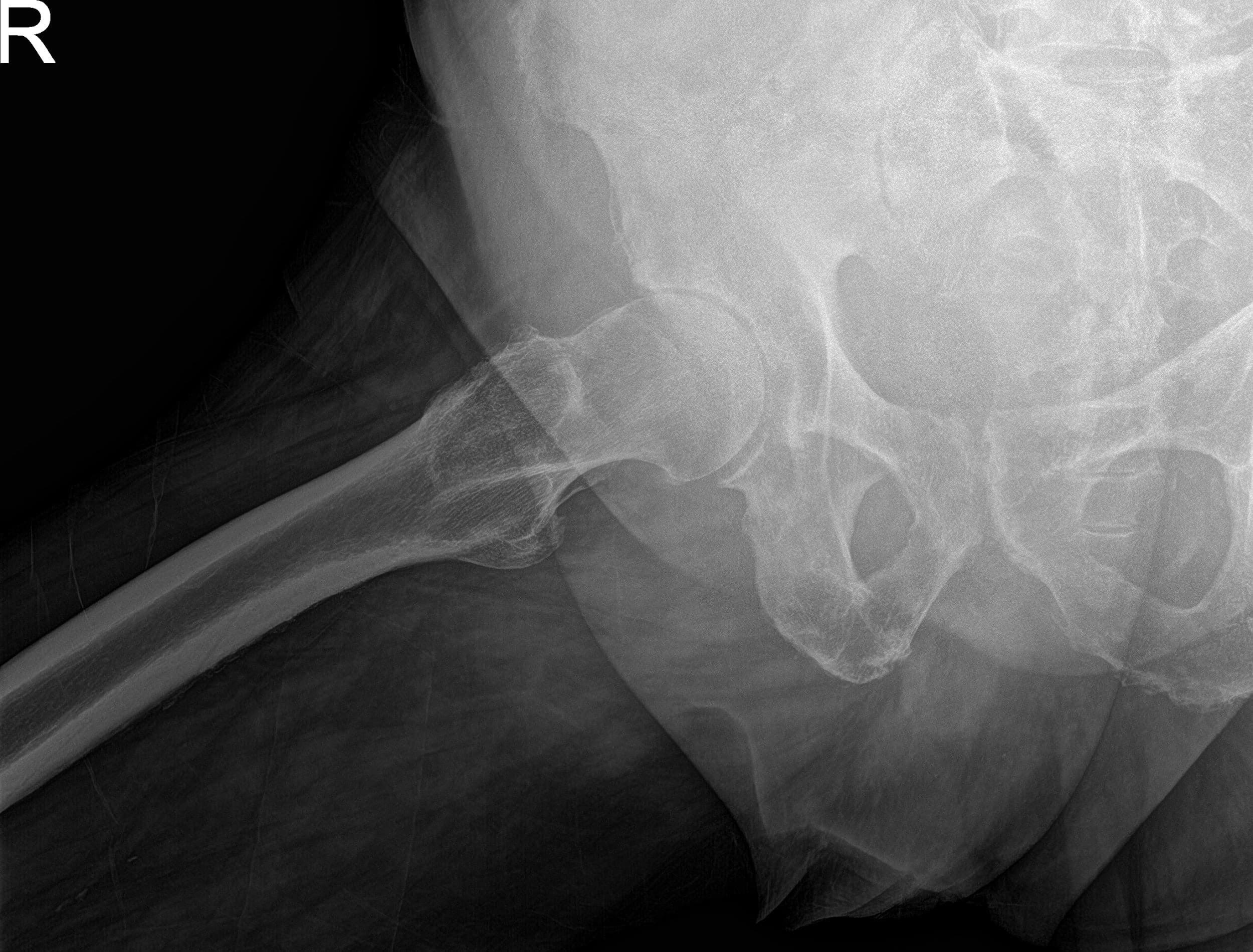 Imágenes de rayos X preoperatorias que muestran la visión lateral de la pata de rana y la pata de rana de la cadera derecha Imágenes de rayos X preoperatorias que muestran la visión lateral de la pata de rana y la pata de rana de la cadera derecha