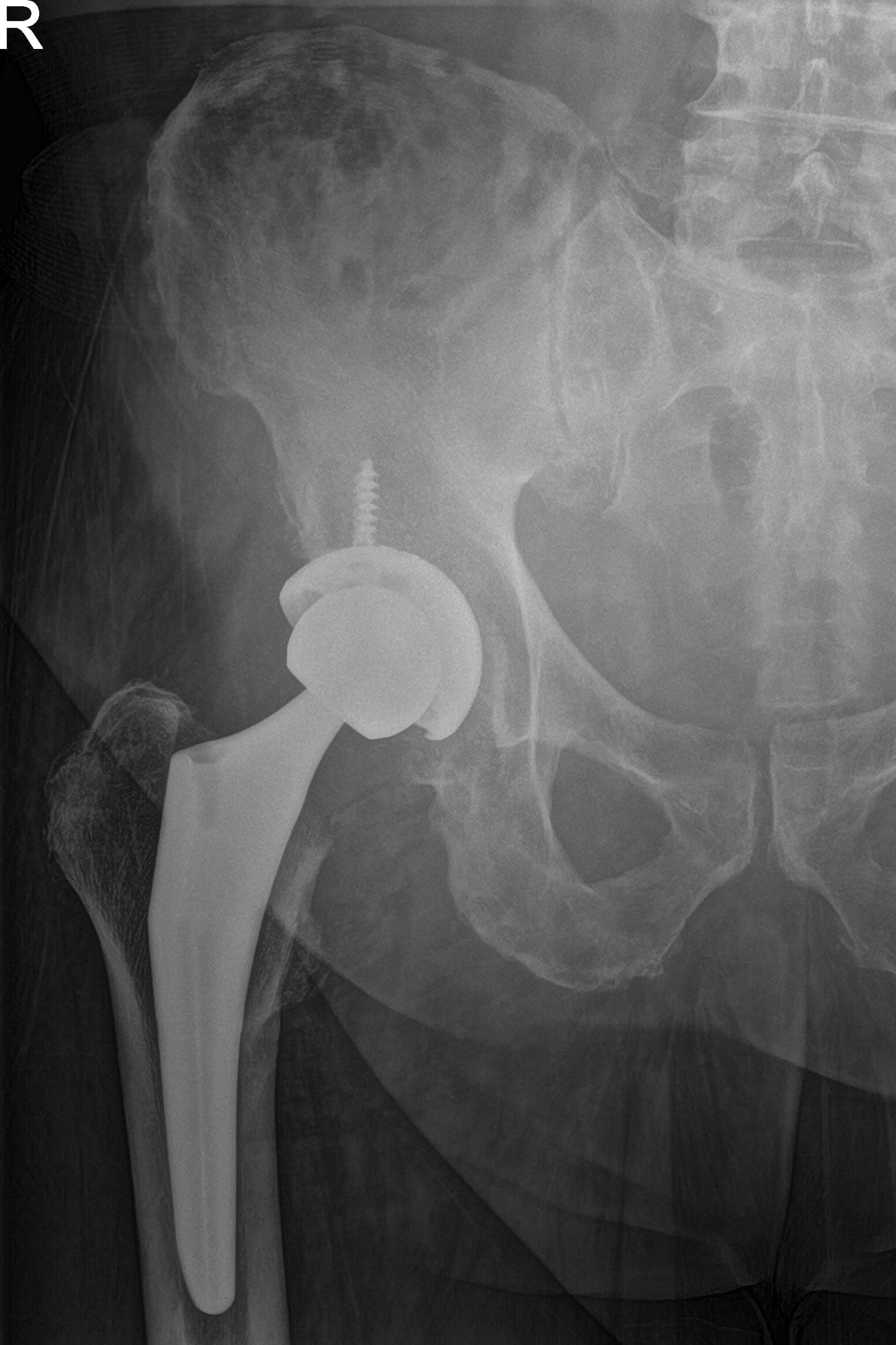 Radiografía postoperatoria que muestra vistas laterales de la cadera derecha y de la pata de rana Radiografía postoperatoria que muestra vistas laterales de la cadera derecha y de la pata de rana