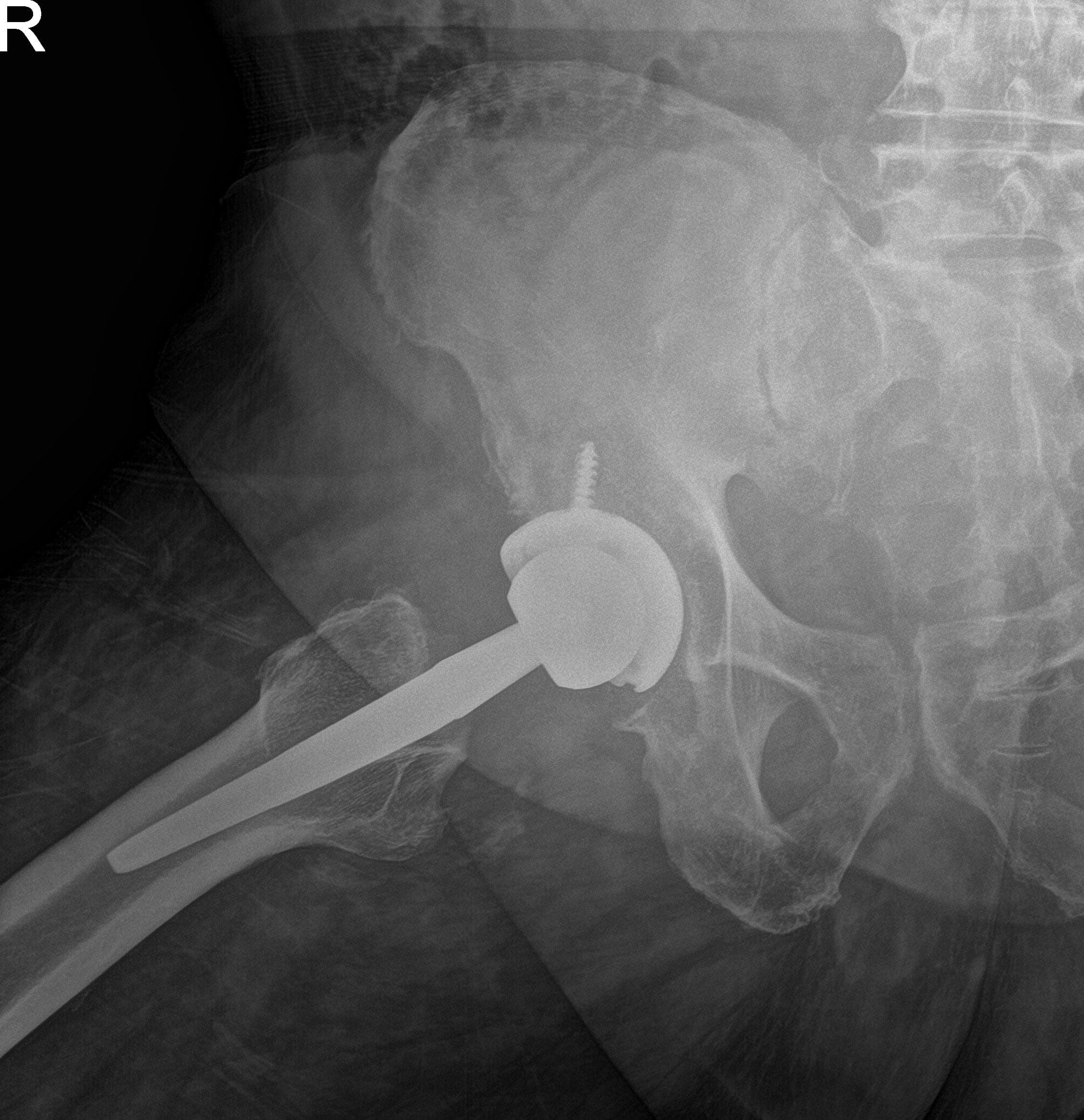 Radiografía postoperatoria que muestra vistas laterales de la cadera derecha y de la pata de rana Radiografía postoperatoria que muestra vistas laterales de la cadera derecha y de la pata de rana