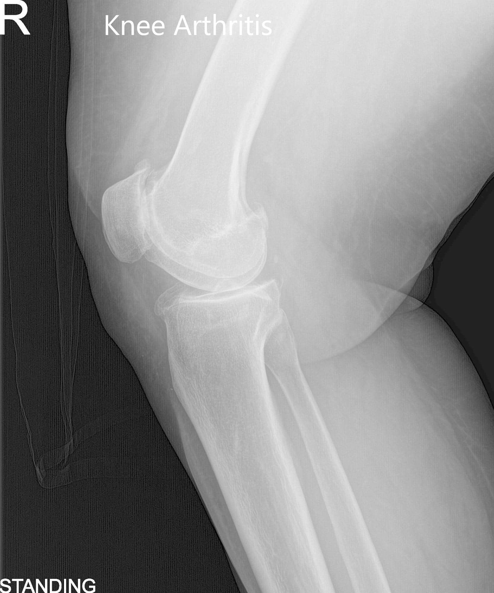 Pre-Operative AP and Lateral X-Ray views of the Right Knee - img 2