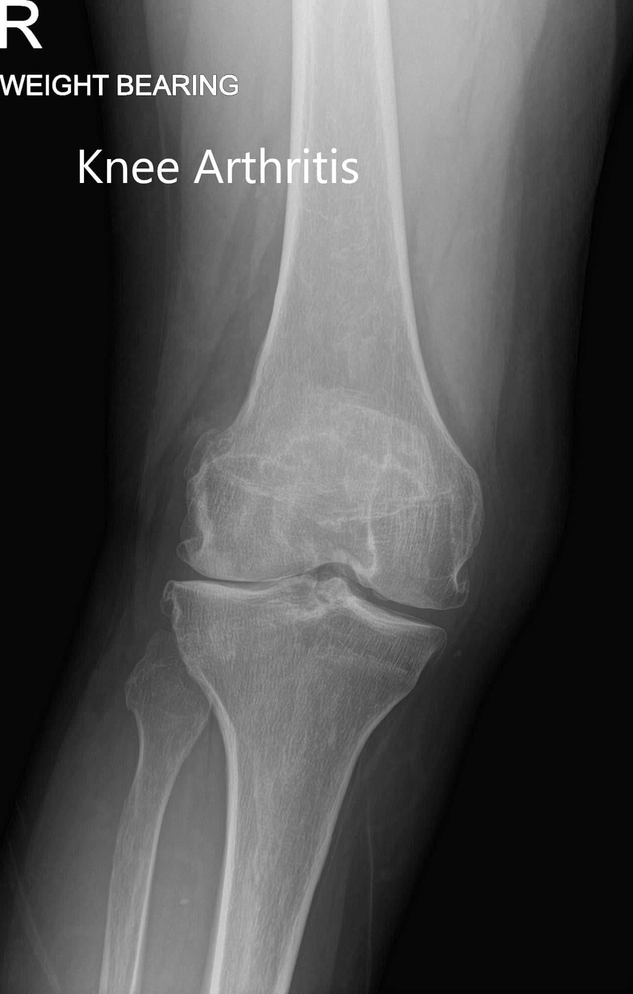Radiografía preoperatoria con soporte de peso que muestra la visión AP y lateral de la rodilla derecha