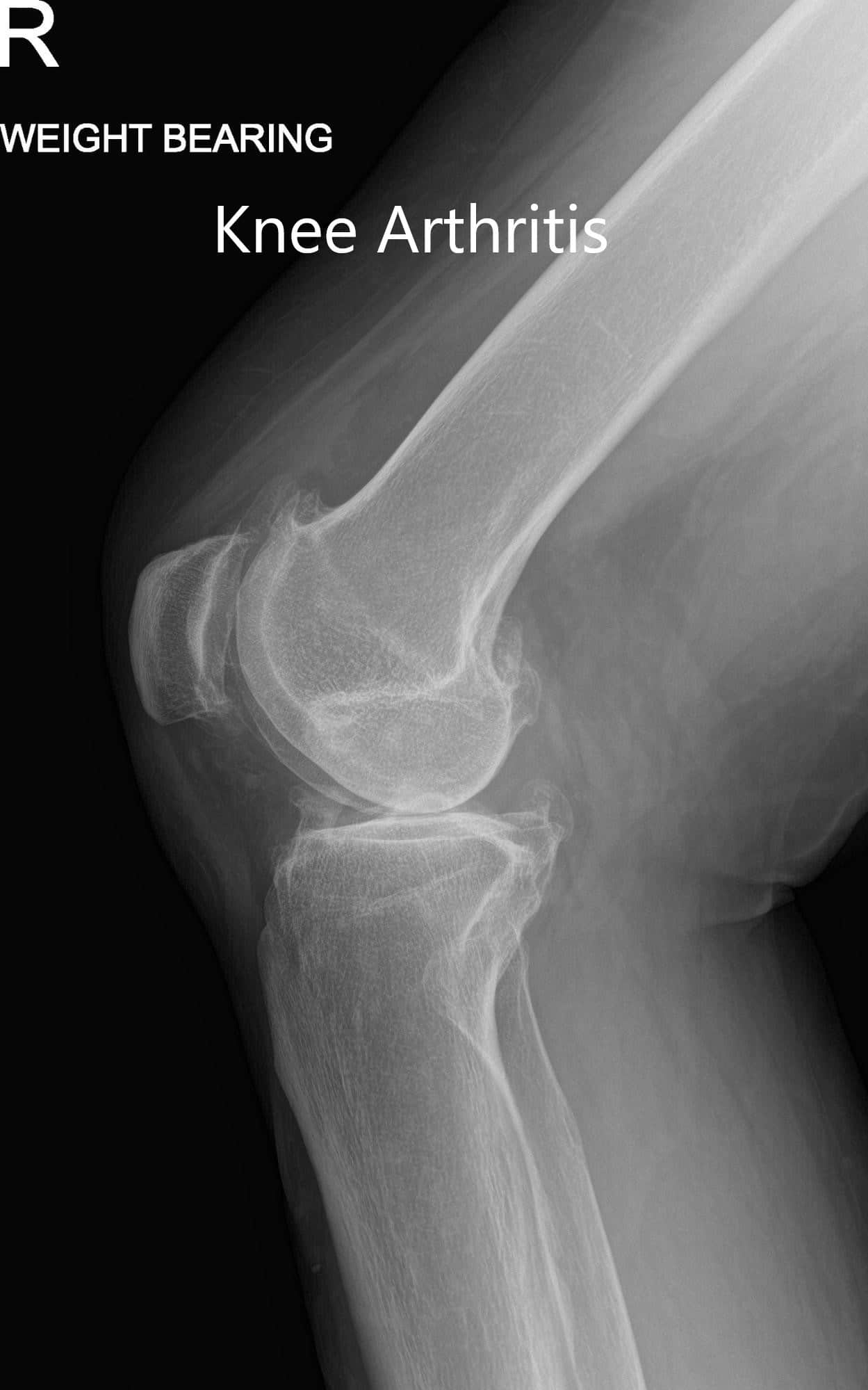 Radiografía preoperatoria con soporte de peso que muestra la AP y las vistas laterales de la rodilla derecha - IMG 2