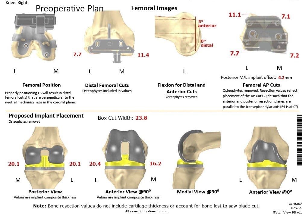Plan quirúrgico específico para paciente de Ortopedia Completa para un reemplazo total de rodilla personalizado en una mujer de 58 años con artritis - ecografía 2