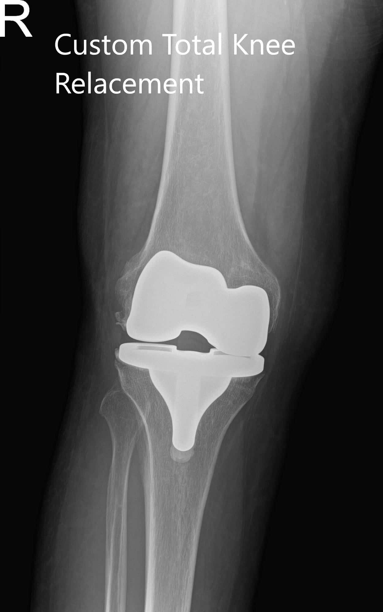 Radiografía postoperatoria del paciente que mostró visión AP y lateral de la rodilla derecha