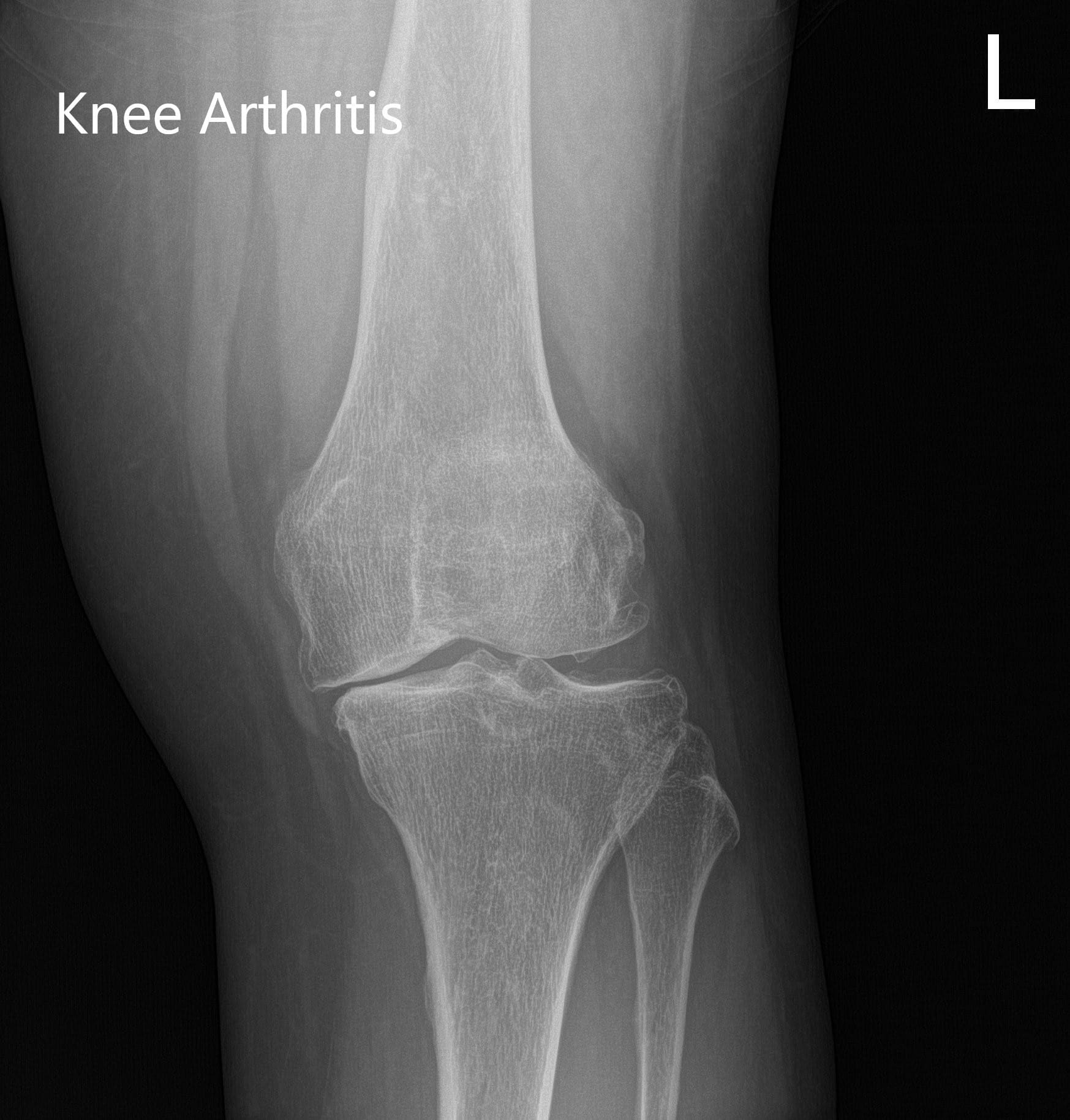 Radiografía preoperatoria que muestra imágenes AP e laterales de la rodilla izquierda