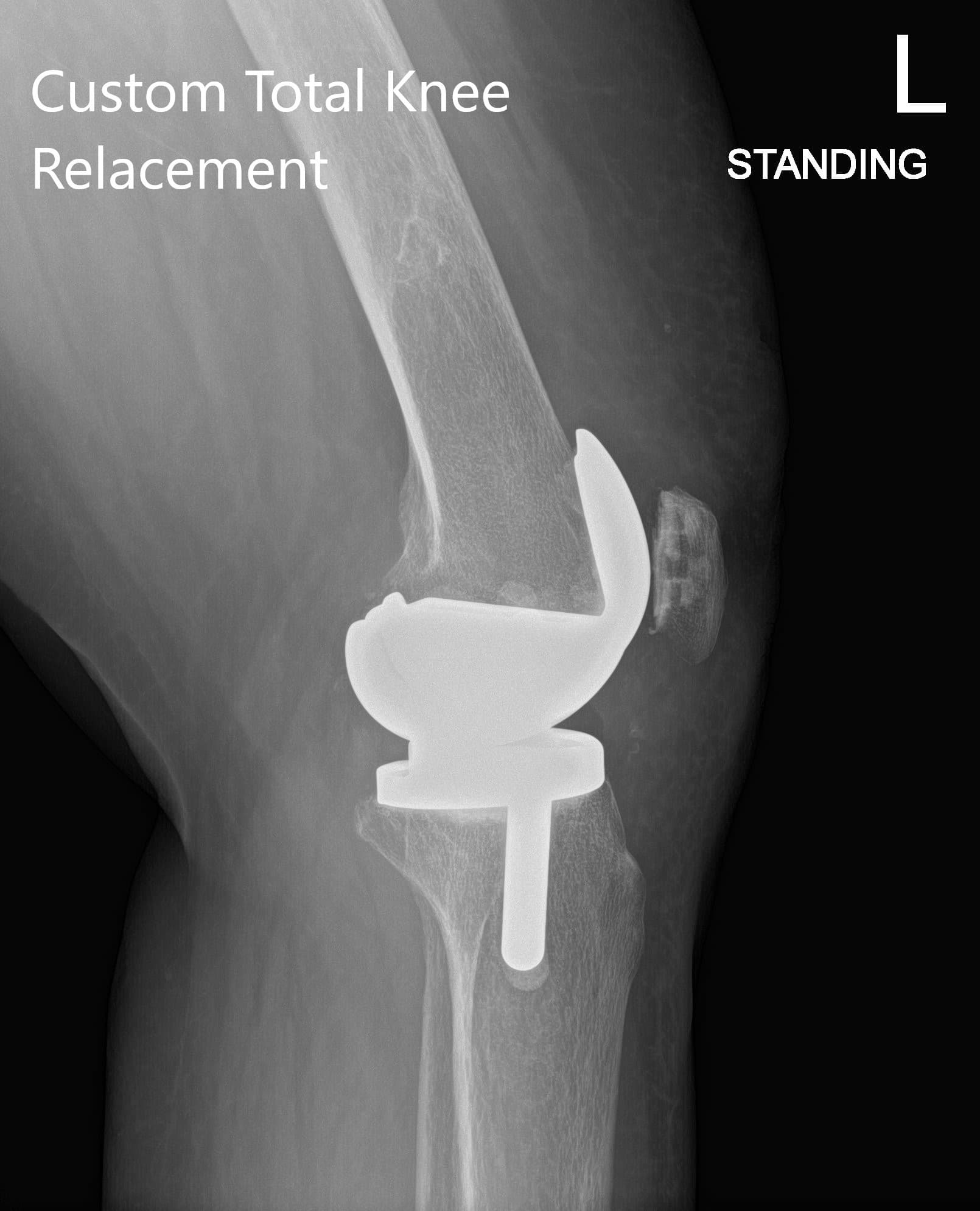 Radiografía postoperatoria que muestra AP y vista lateral de la rodilla izquierda - IMG 2