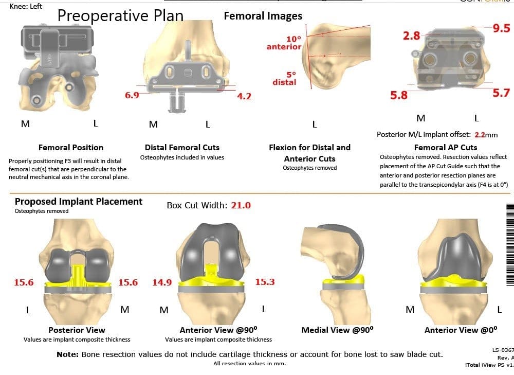 Plan quirúrgico completo específico para pacientes de Ortopedia para un reemplazo total de rodilla personalizado en un hombre de 59 años - ecografía 2