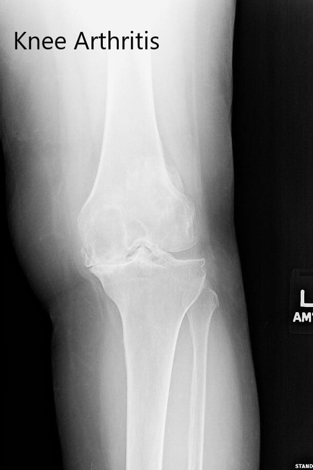 Radiografía preoperatoria de la rodilla izquierda que mostró osteoartritis severa en las vistas anteroposterior y lateral Radiografía preoperatoria de la rodilla izquierda que mostró osteoartritis severa en las vistas anteroposterior y lateral