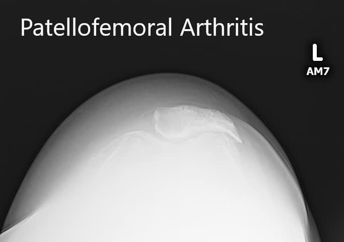 Radiografía preoperatoria que muestra la vista de la rótula con artritis patelofemoral severa Radiografía preoperatoria que muestra la vista de la rótula con artritis patelofemoral severa