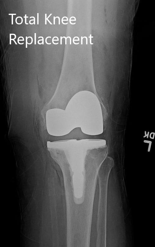 Radiografía postoperatoria que muestra la articulación de la rodilla izquierda con prótesis en vistas anteroposterior y lateral Radiografía postoperatoria que muestra la articulación de la rodilla izquierda con prótesis en vistas anteroposterior y lateral