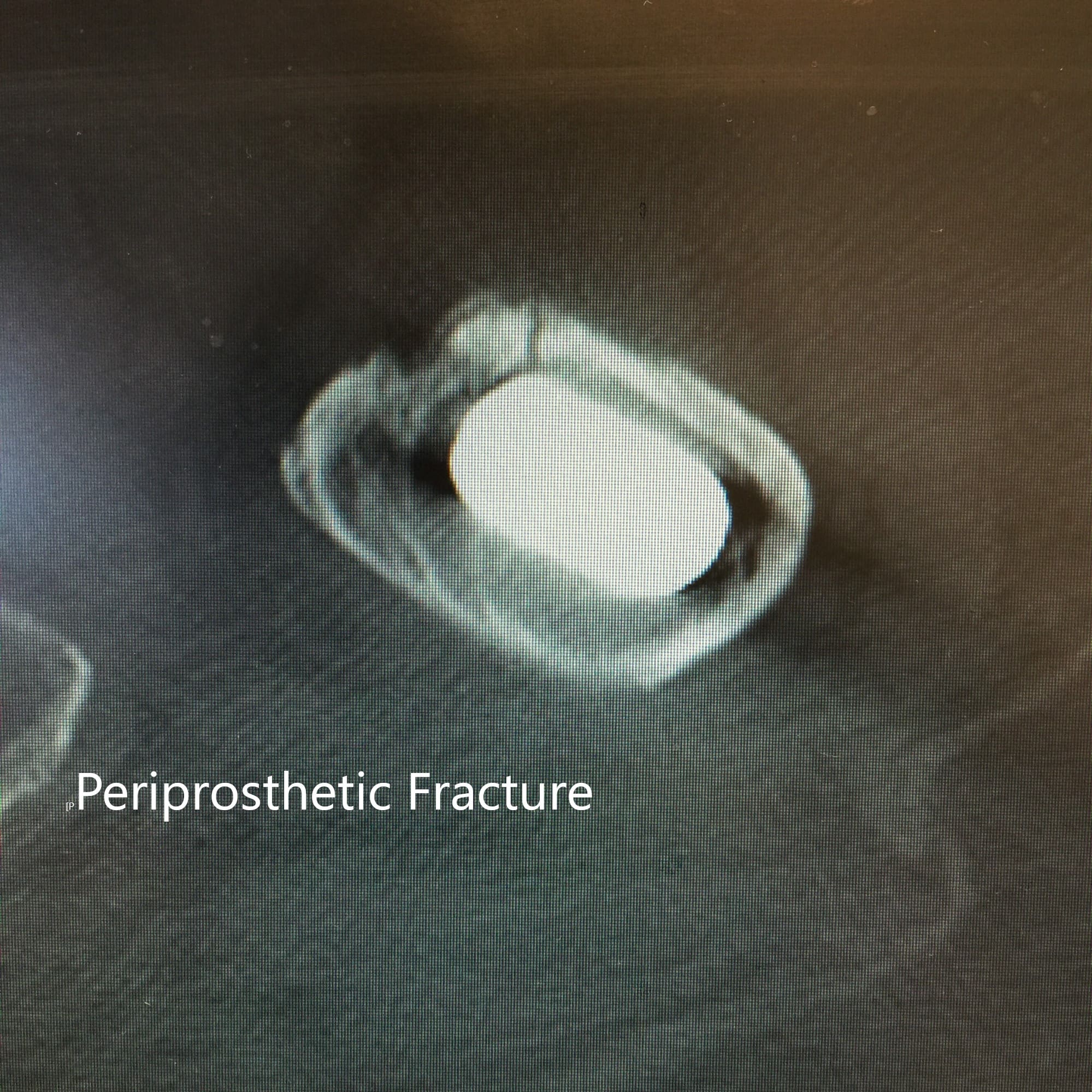La tomografía computarizada y la radiografía de la cadera izquierda revelaron una fractura periprotésica no desplazada del fémur proximal anteromedial con hundimiento del tallo