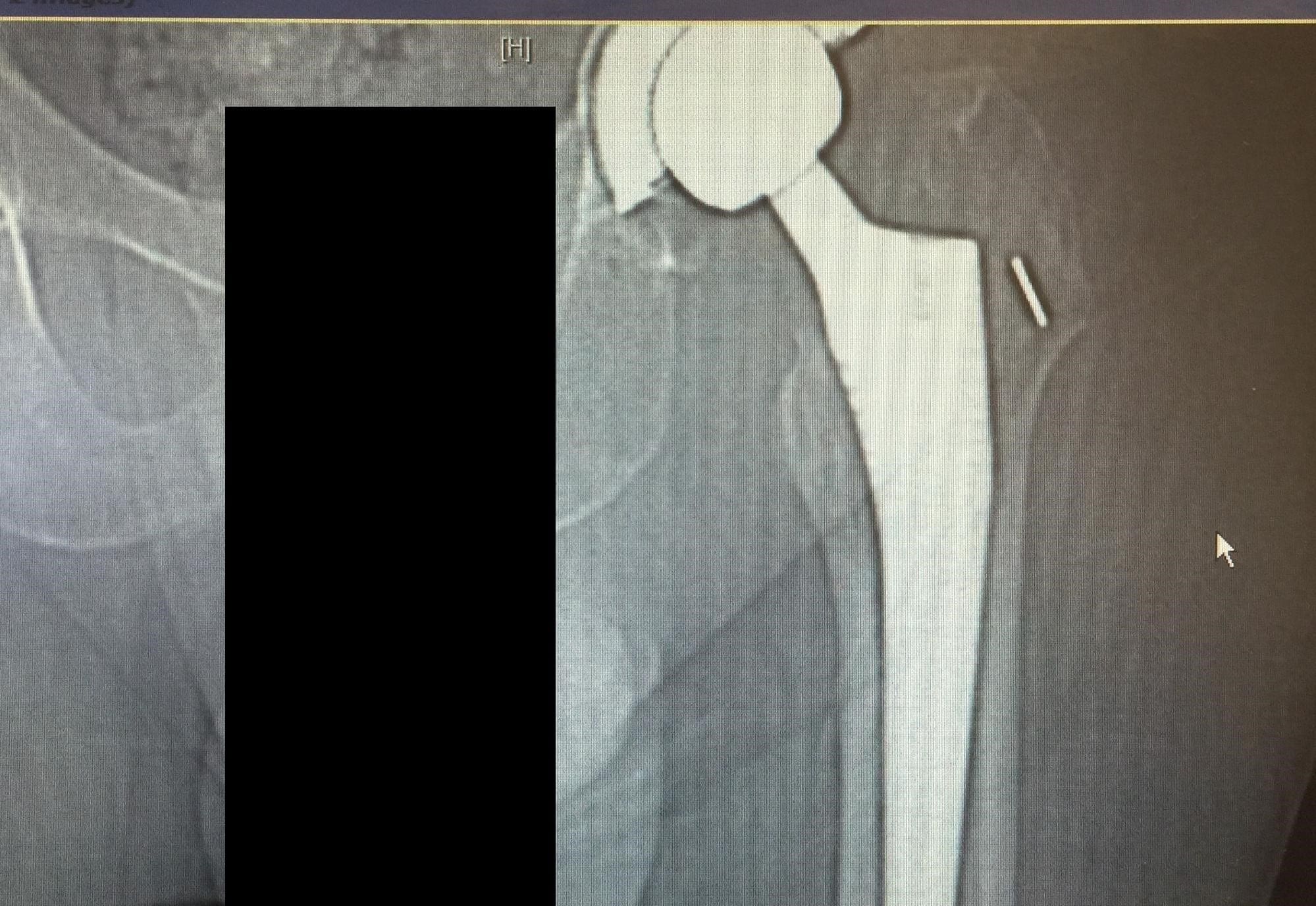 La tomografía computarizada y la radiografía de la cadera izquierda revelaron una fractura periprotésica no desplazada del fémur proximal anteromedial con hundimiento del vástago - img 2