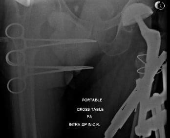 Radiografías intraoperatorias y postoperatorias que muestran cables usados para la fijación de fracturas y el vástago femoral largo revisado