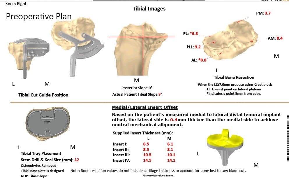 Plan quirúrgico completo específico para pacientes de Ortopedia para una artroplastia personalizada de rodilla derecha en un hombre de 83 años