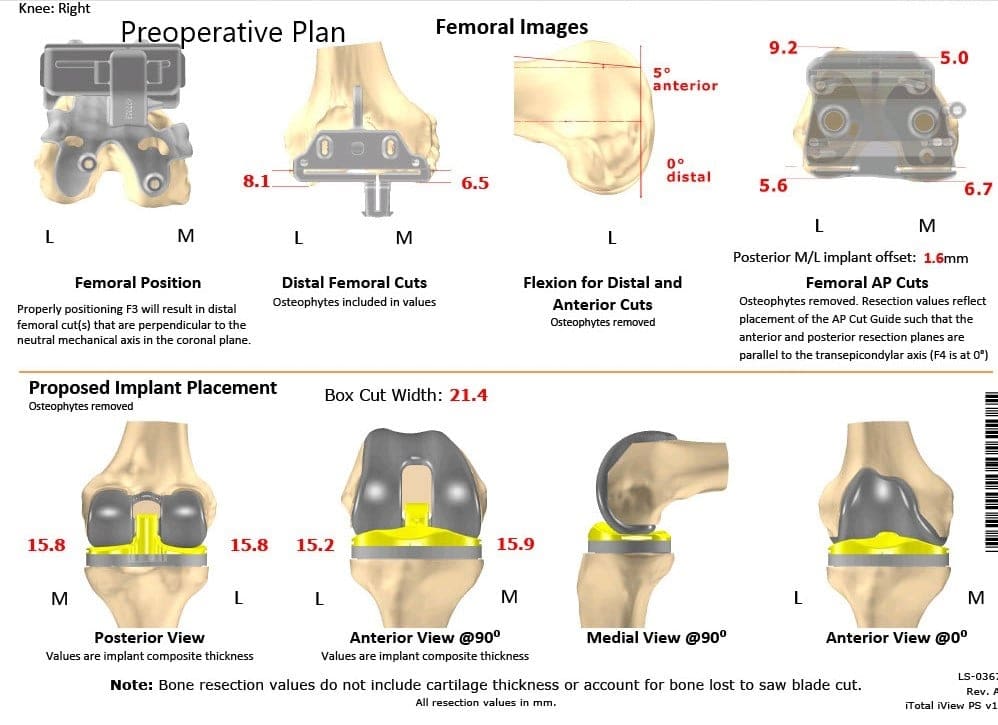 Plan quirúrgico completo específico para paciente de Ortopedia para una artroplastia personalizada de rodilla derecha en un hombre de 83 años - escaneo 2