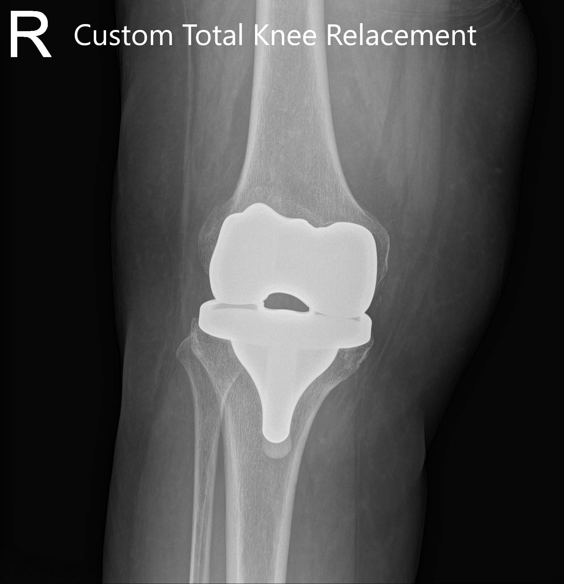 Radiografía postoperatoria de la rodilla derecha que muestra vistas AP y laterales