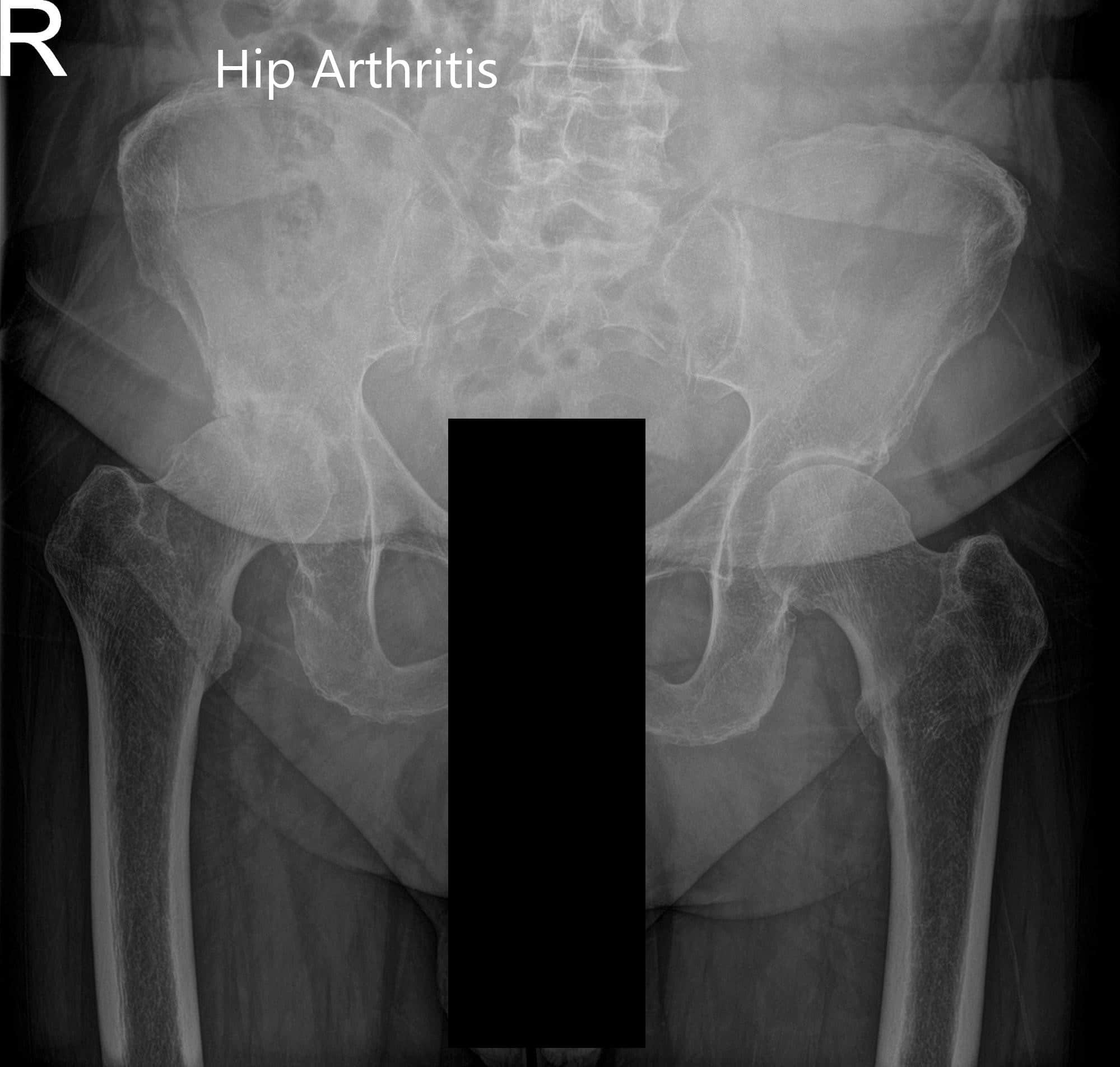 Radiografía preoperatoria de la pelvis vista AP y vista lateral de la cadera derecha con pata de rana