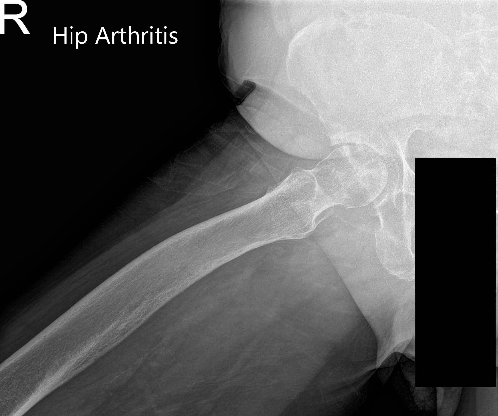 Radiografía preoperatoria de la pelvis vista AP y vista lateral con pata de rana de la cadera derecha - img 2