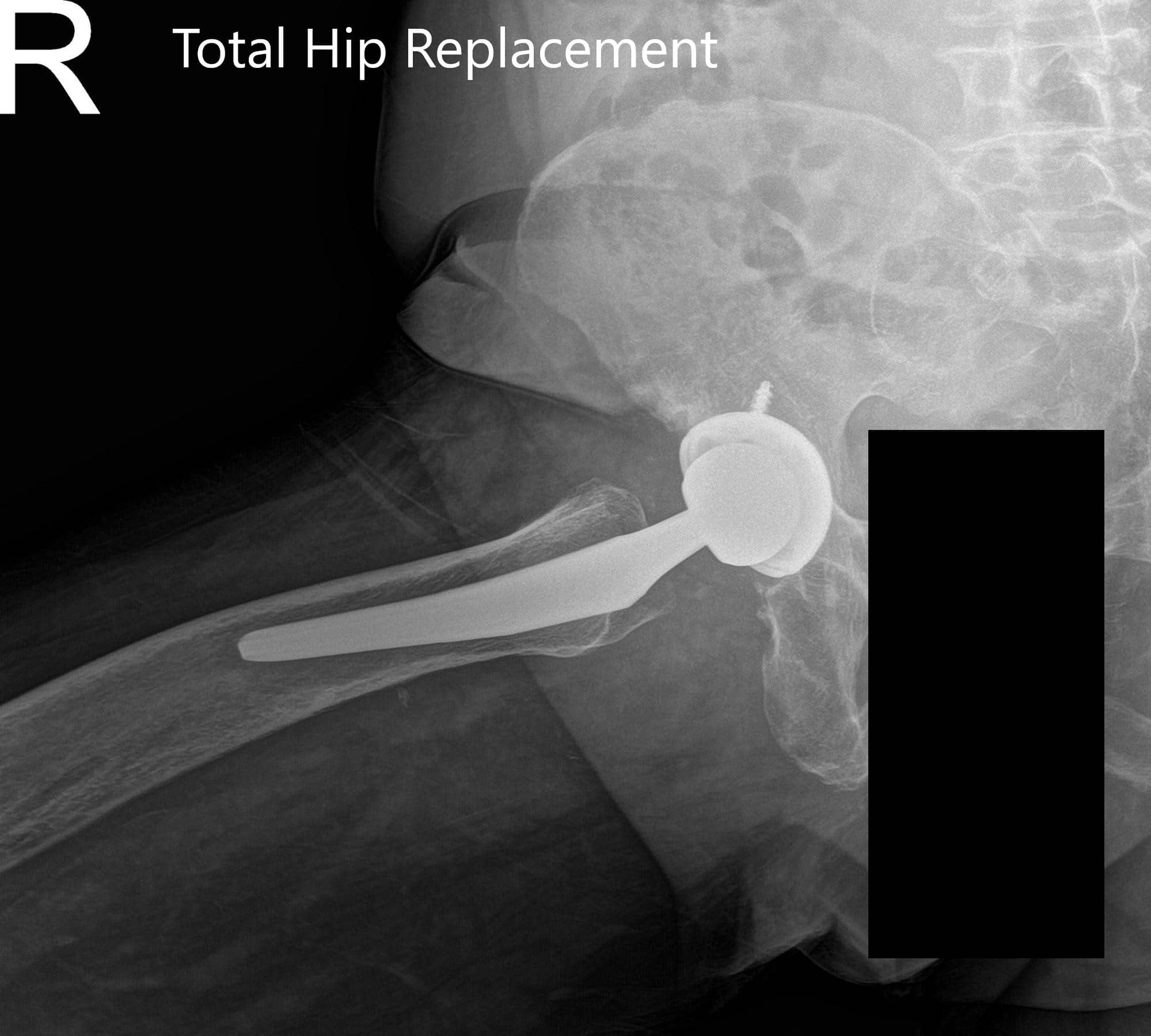 Radiografía postoperatoria que muestra la vista AP de la pelvis y la vista lateral en forma de rana de la cadera derecha.