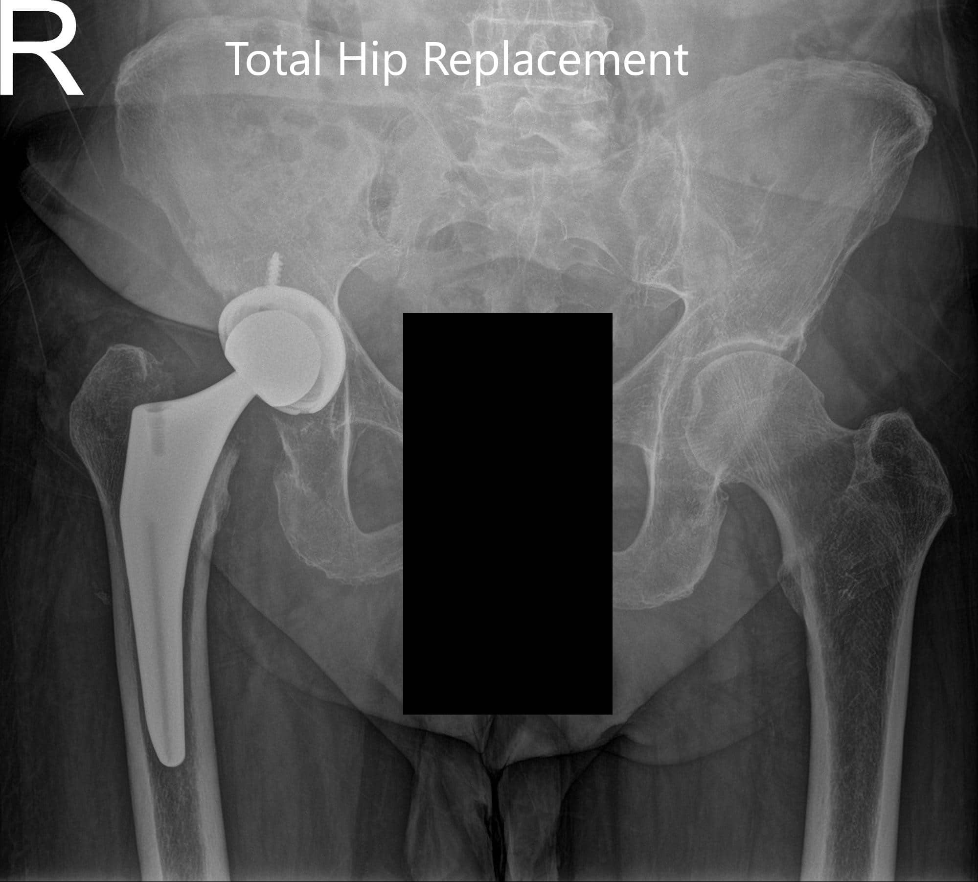 Radiografía postoperatoria que muestra la vista en ángulo de la pelvis y la vista lateral en forma de rana de la cadera derecha - img 2