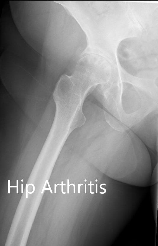 Radiografía preoperatoria que muestra la visión de la pata en forma de rana y la vista lateral de la cadera derecha con patas de rana - img 2