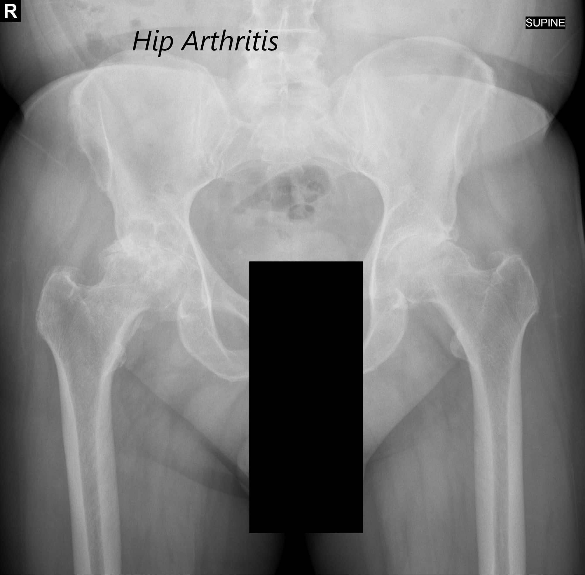 AP view of the Pelvis X ray showing both hip joints with frog leg lateral views of the right and left hip joints suggesting severe bilateral osteoarthritis of the hip joints AP view of the Pelvis X ray showing both hip joints with frog leg lateral views of the right and left hip joints suggesting severe bilateral osteoarthritis of the hip joints
