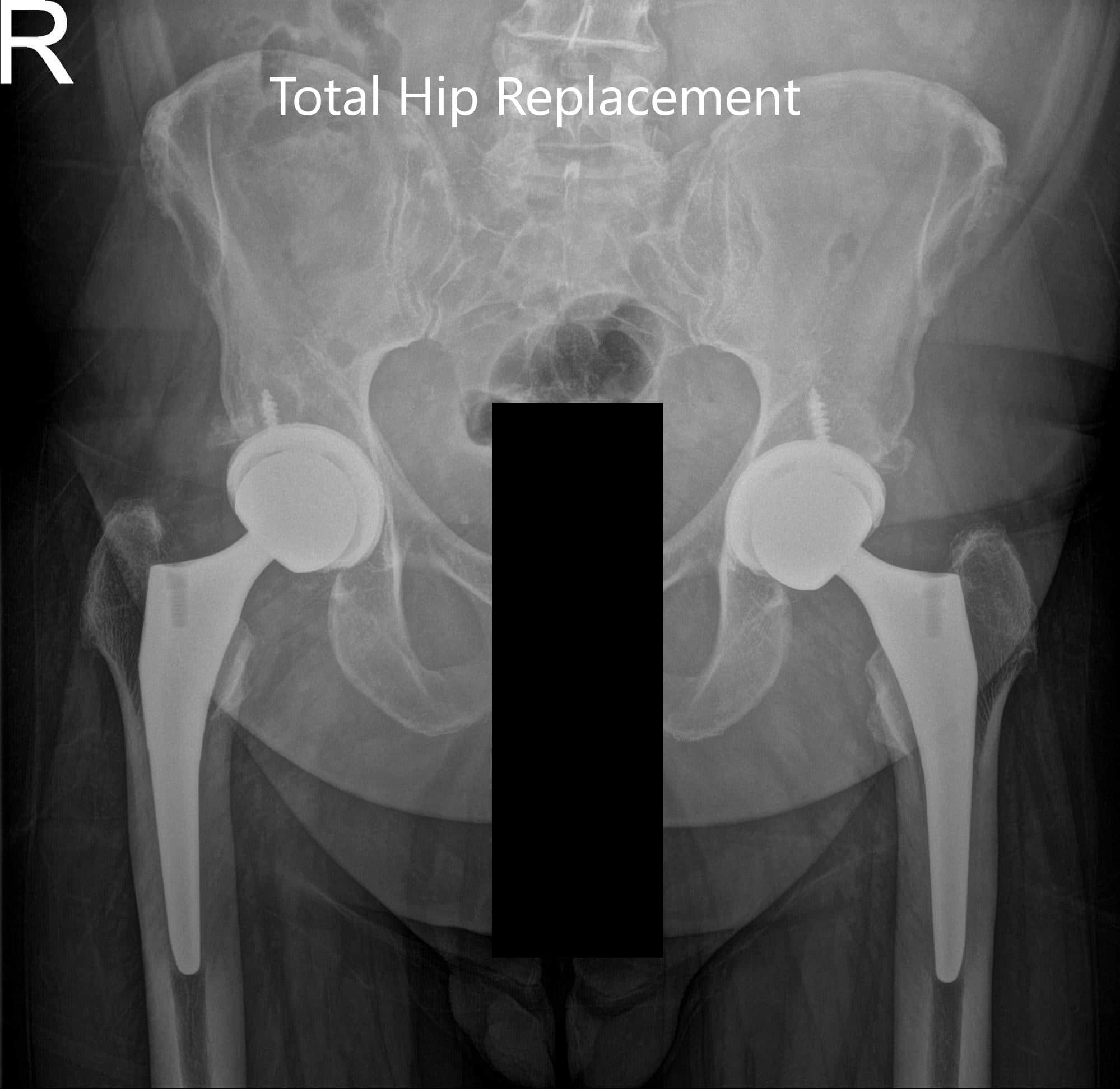 Postoperative AP view of the Pelvis X-ray showing both hip joints with frog-leg lateral views of the right and left hip joints Postoperative AP view of the Pelvis X-ray showing both hip joints with frog-leg lateral views of the right and left hip joints