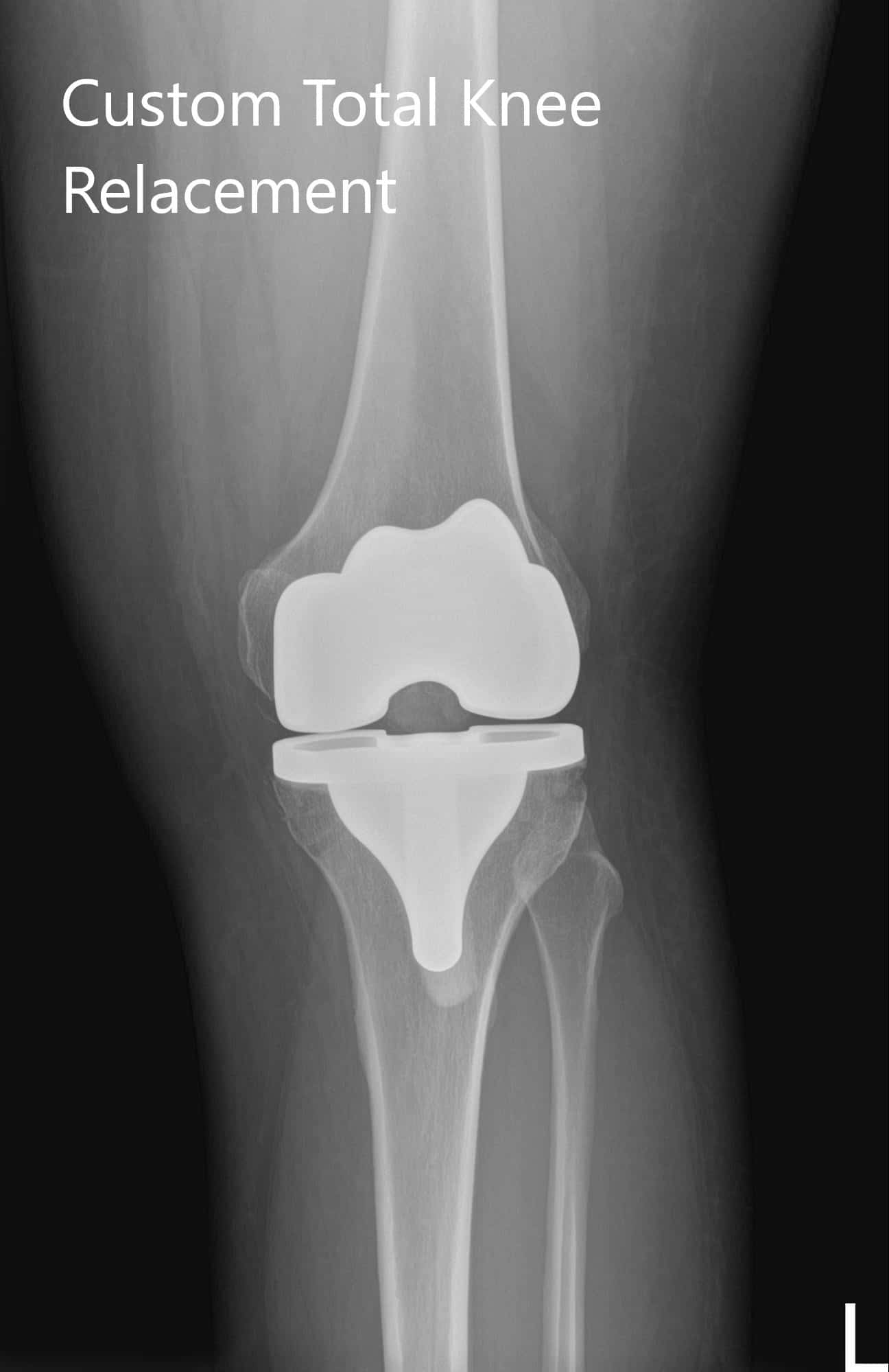 Radiografía postoperatoria de la rodilla izquierda que muestra imagen AP y lateral