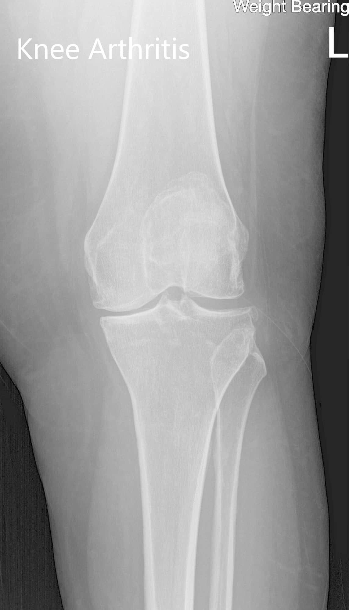 Radiografía preoperatoria de la rodilla izquierda que mostró vistas AP y laterales