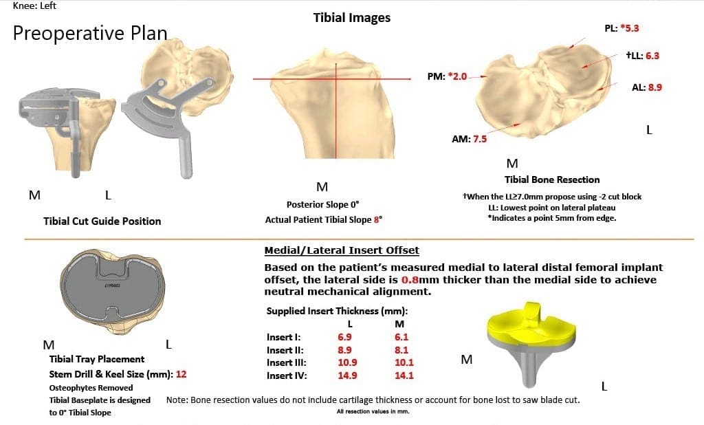 Plan quirúrgico completo específico para pacientes en ortopedia para un reemplazo personalizado de rodilla izquierda en un hombre de 40 años