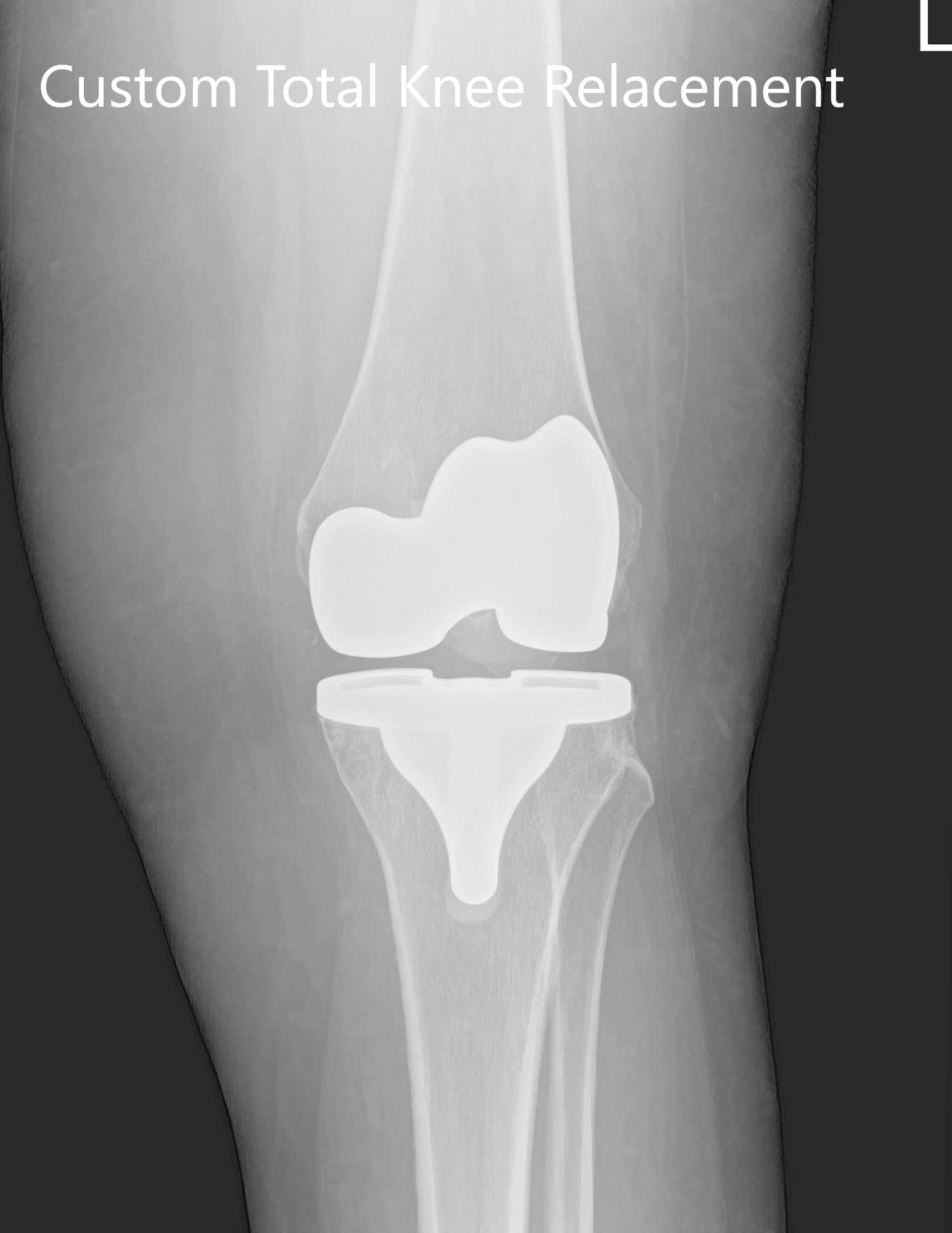Tres meses después de la operación radiografía de la rodilla izquierda que muestra imágenes AP e laterales - img 2