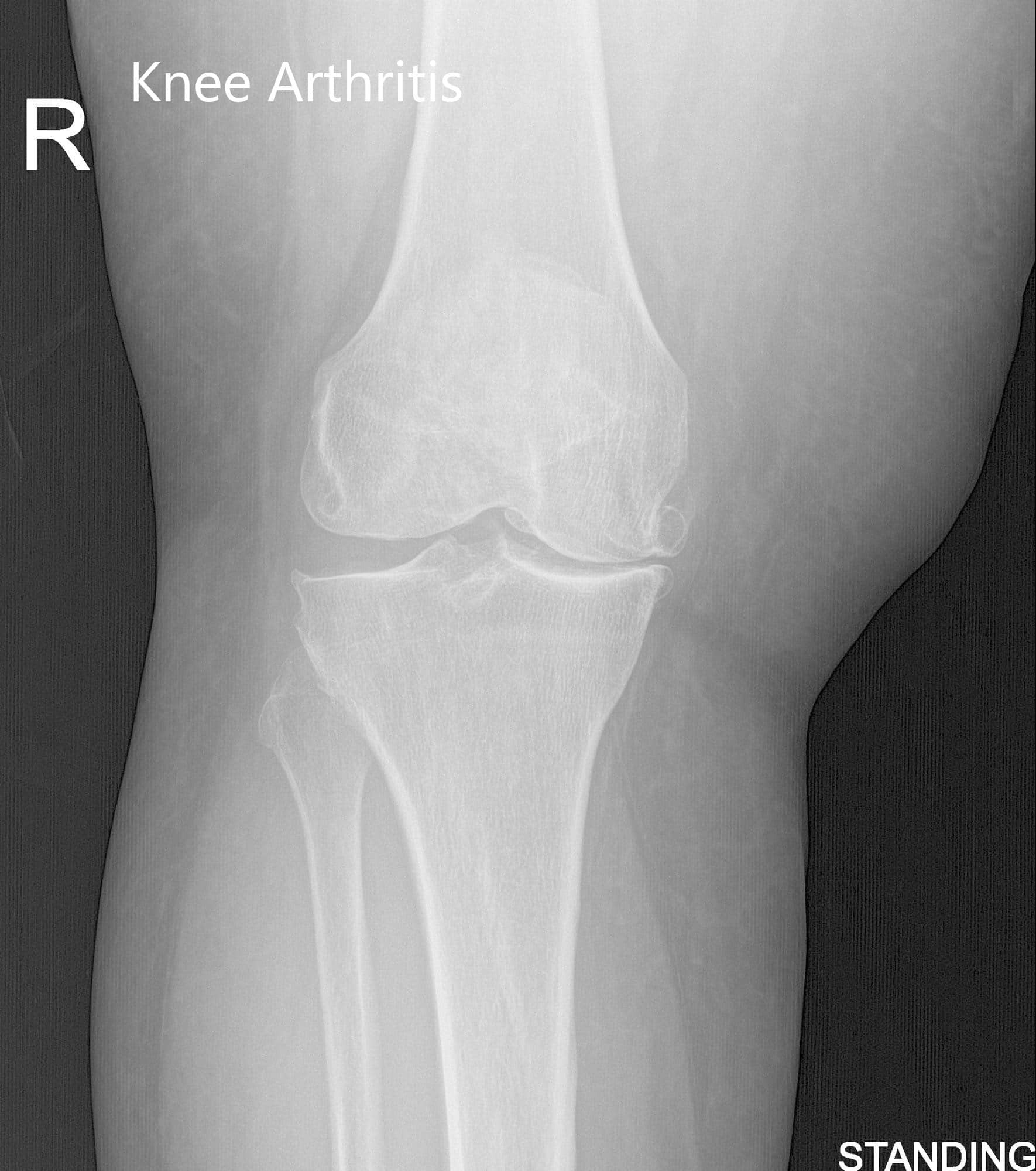 Vistas preoperatorias de la rodilla derecha (de pie)