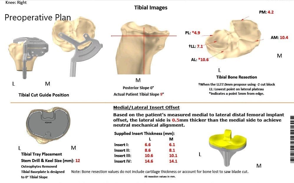 Plan quirúrgico completo específico para pacientes de Ortopedia para una artroplastia personalizada de rodilla total derecha - hombre de 62 años