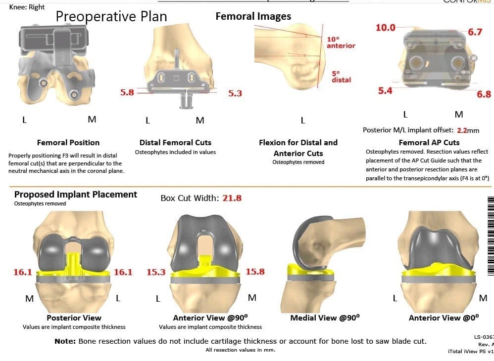 Plan quirúrgico completo específico para pacientes de Ortopedia para una artroplastia personalizada de rodilla derecha total - hombre de 62 años - escaneo 2