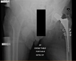 Radiografía postoperatoria que muestra vista AP de la pelvis en ambas caderas, cadera izquierda con alambres de cerclaje y espaciador antibiótico in situ
