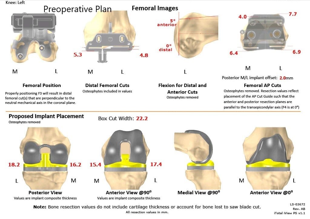 Plan quirúrgico completo de ortopedia específico para un reemplazo personalizado de rodilla izquierda en una mujer de 67 años - ecografía 2