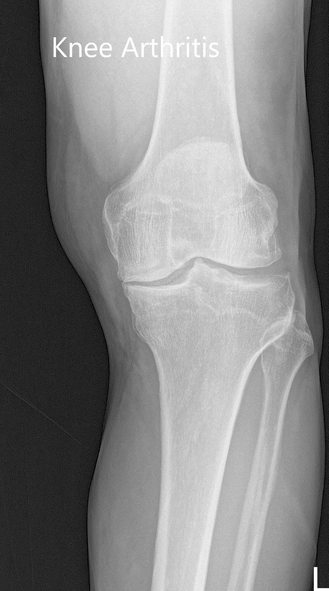 Radiografía preoperatoria de la rodilla izquierda que mostró vistas AP y laterales