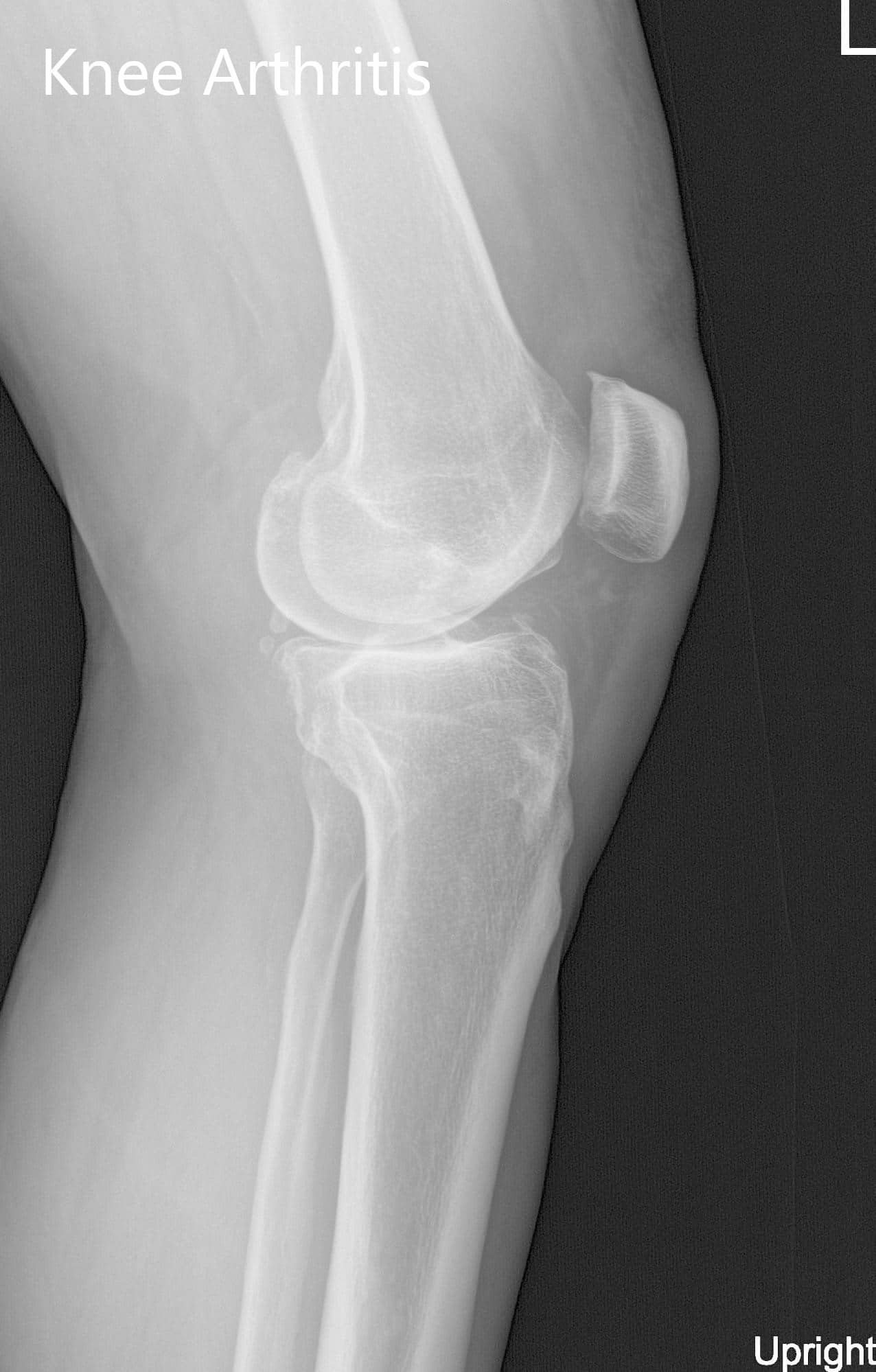 Radiografía preoperatoria de la rodilla izquierda que muestra visión AP y lateral - img 2
