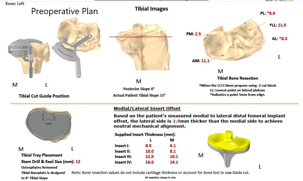Plan quirúrgico completo específico para pacientes en ortopedia para un reemplazo personalizado de rodilla izquierda en una mujer de 70 años