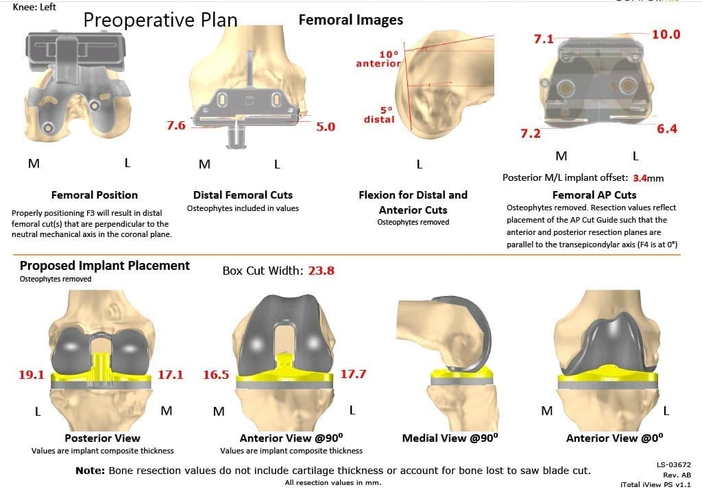 Plan quirúrgico completo específico para paciente en ortopedia para un reemplazo personalizado de rodilla izquierda en una mujer de 70 años - ecografía 2