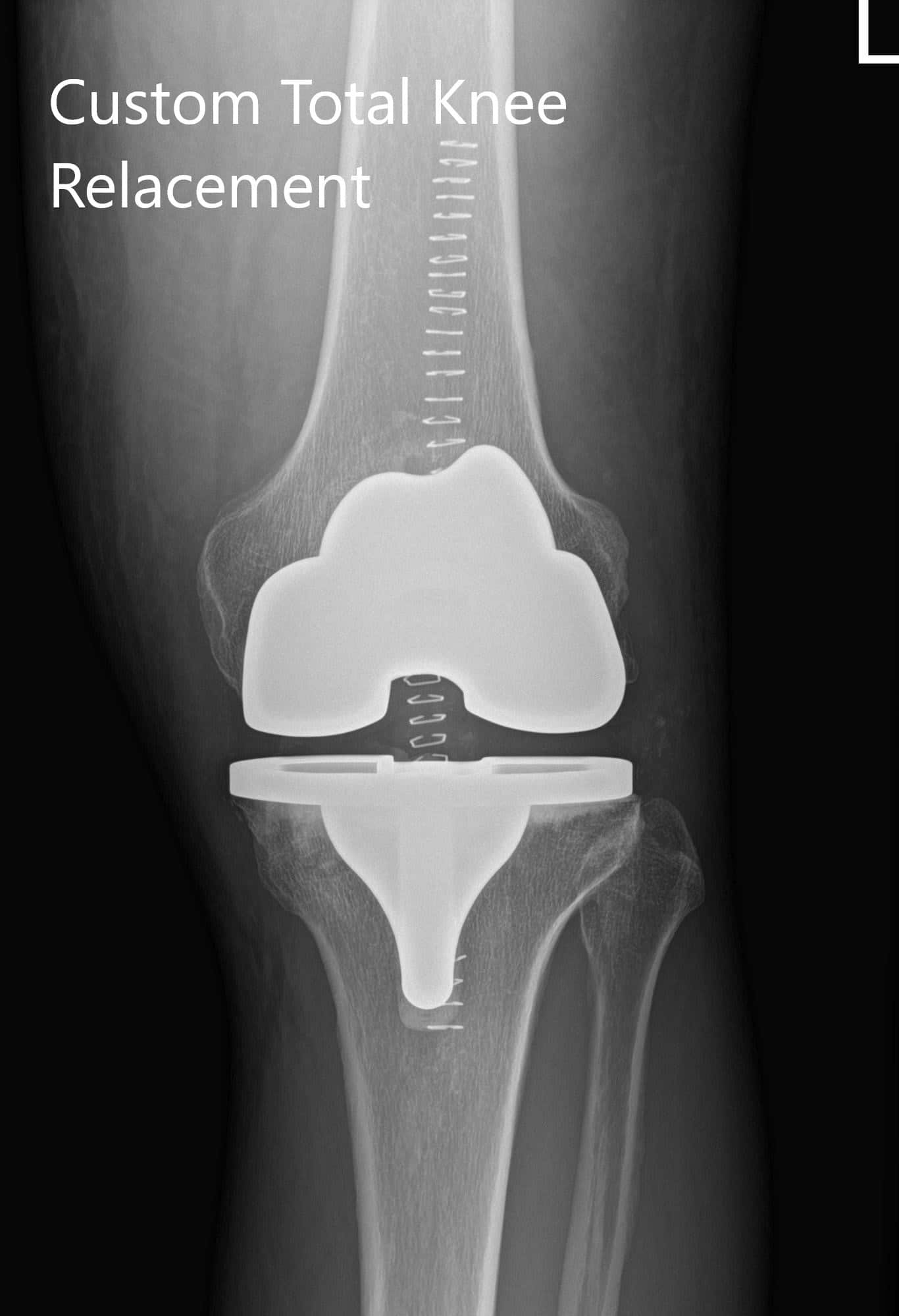 Radiografía preoperatoria de la rodilla izquierda que mostró vistas AP y laterales