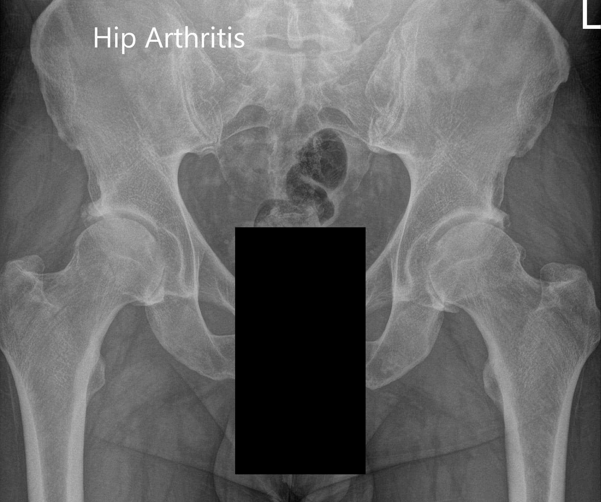Radiografía preoperatoria de la vista AP de la pelvis y la vista lateral de la cadera izquierda